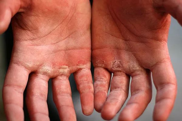 kaiyun体育 健身担心手有老茧，这该怎么办？